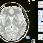 New Brain Implant Can Decode a Person’s “Inner Voice”